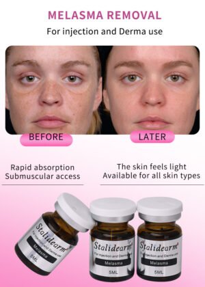 Melasma-Stalidearm meso