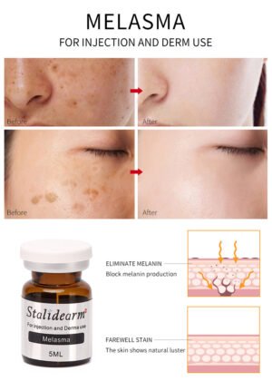 Melasma-Original Stalidearm Meso Injection