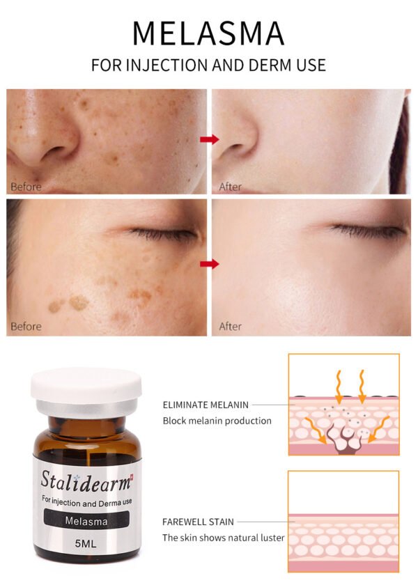 Melasma-Original Stalidearm Meso Injection